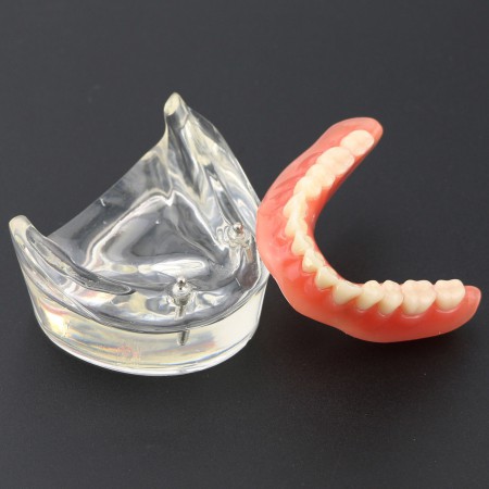 Prothèse Modèle Dentaire Couvert-dentier Inférieur avec 2 Implantations  d'Étude de Démo Modèle 6002 01 en france - matérieldentaire.fr
